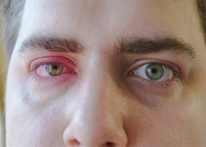 أعراض الذئبة الحمراء في العين