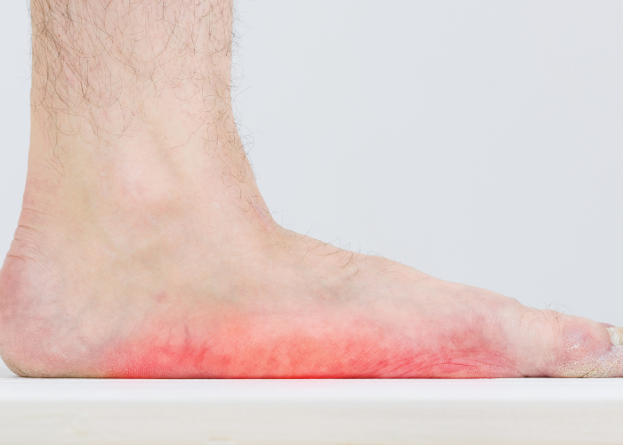 تمارين علاج القدم المسطحة للكبار