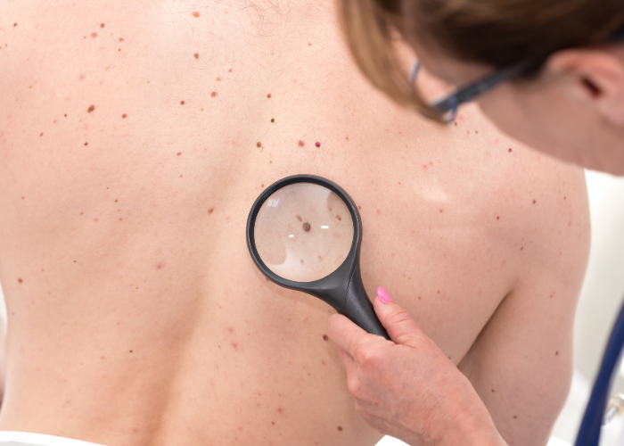 هل سرطان الجلد معدي