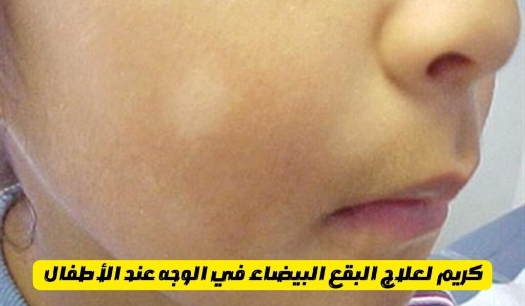 كريم لعلاج البقع البيضاء في الوجه عند الأطفال ، كيف اعالج البقع البيضاء في المنزل؟ ما هو علاج البقع البيضاء في الوجه عند الاطفال؟