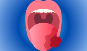أعراض سرطان الفم المبكرة ، كيف اعرف اني مصاب بسرطان الفم؟ اعراض ما قبل سرطان الفم؟ كيف يكون شكل سرطان الفم واللثة؟ ما هي مراحل سرطان الفم؟